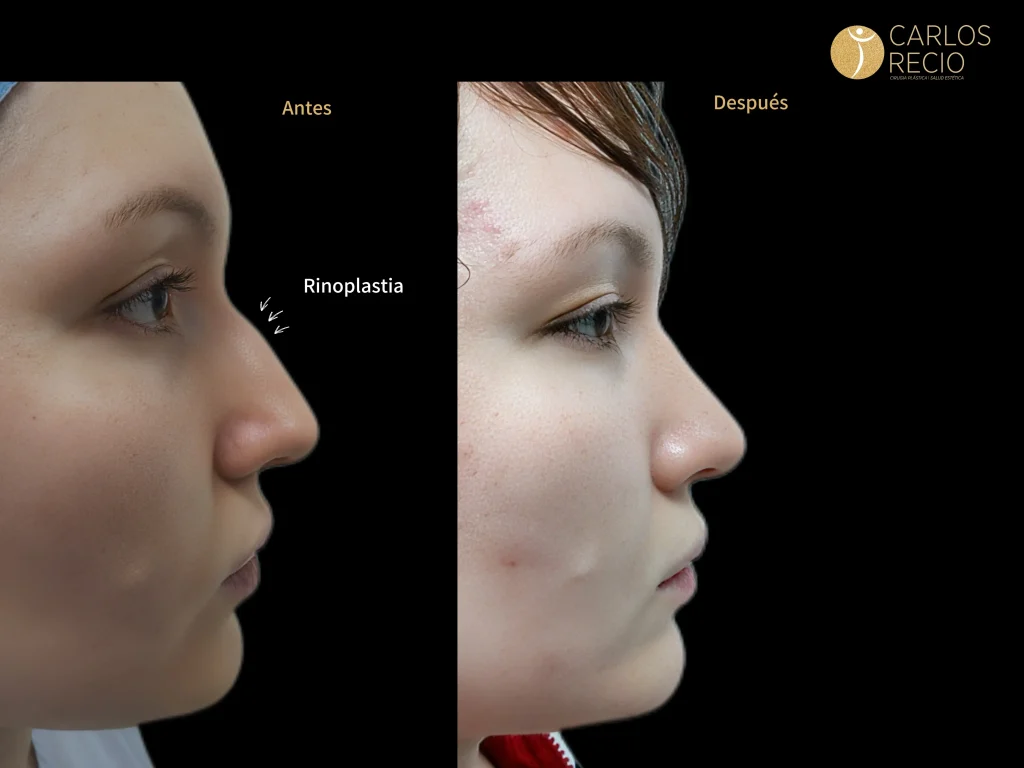 Rinoplastia: la cirugía que transforma tu perfil El éxito de una rinoplastia